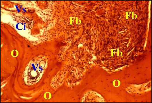 Fibromatose