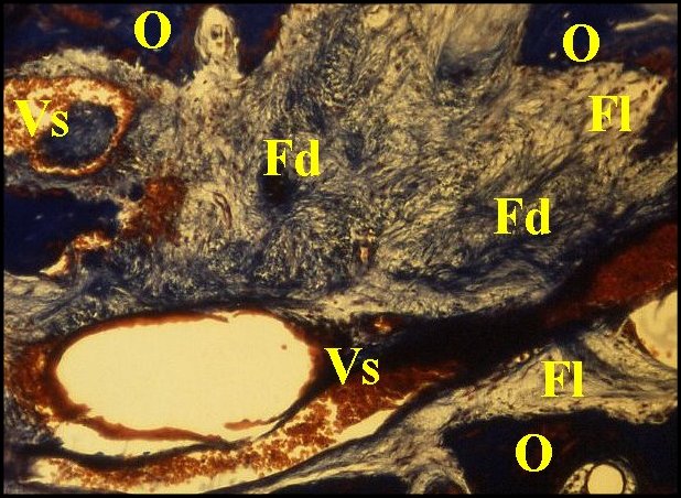 Fibrose trichrome