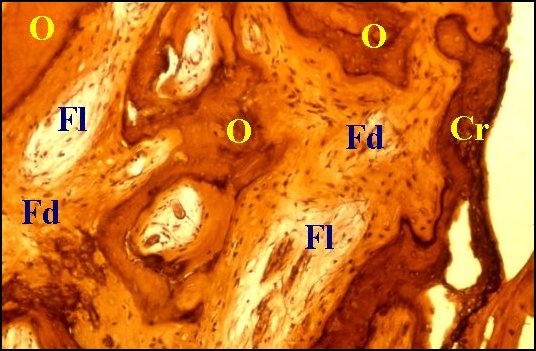 Fibrose, lyse 1