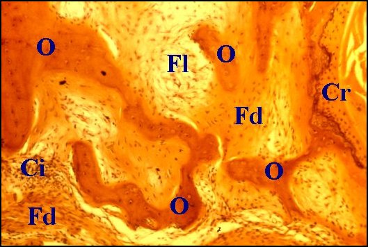 Fibrose, lyse 2