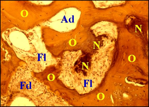 Fibrose, nécrose