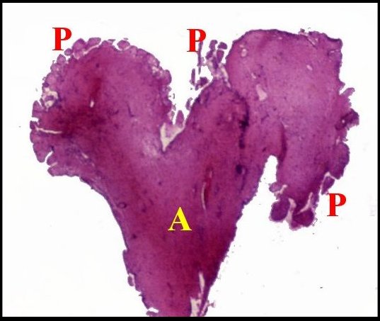 Papillome 1