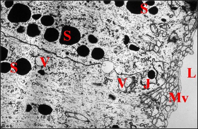 Petits adénocytes, cyto.