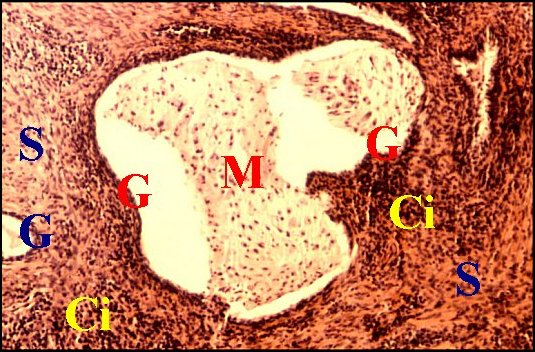 Pseudo-gl. kystifiée