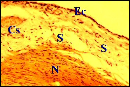 Schwannome 1