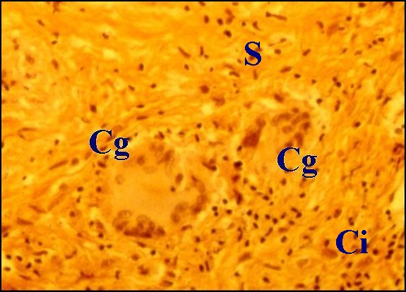 Tuberculose Langhans