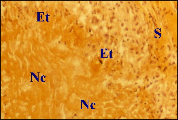 Tuberculose epith.,necrose