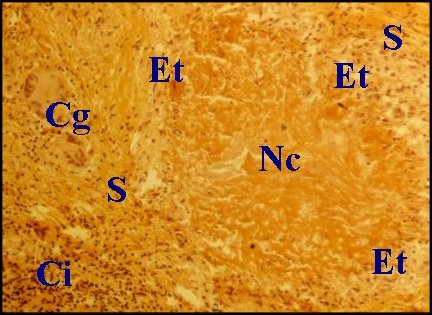 Tuberculose granulome