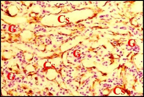 Tumeur glomique 2