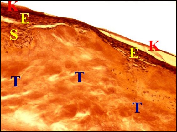 Tympanosclérose 2